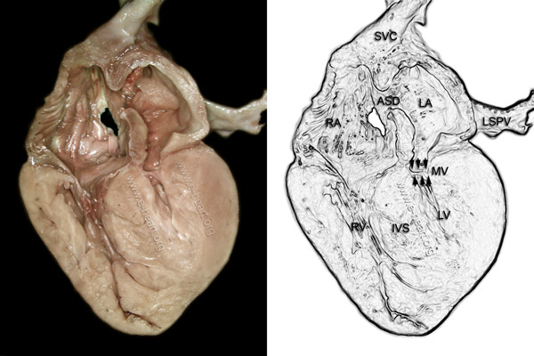 Mitral Valve Hypoplasia